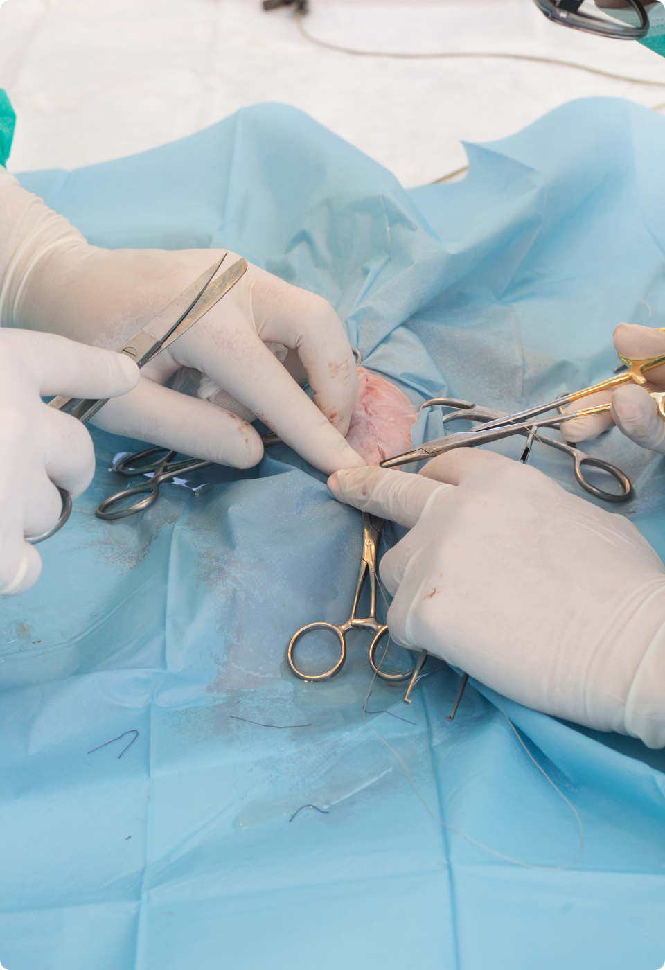 Tre mani guantate usano strumenti chirurgici per operare su un tessuto sotto un telo sterile blu, con forbici e pinze visibili, durante una procedura medica.